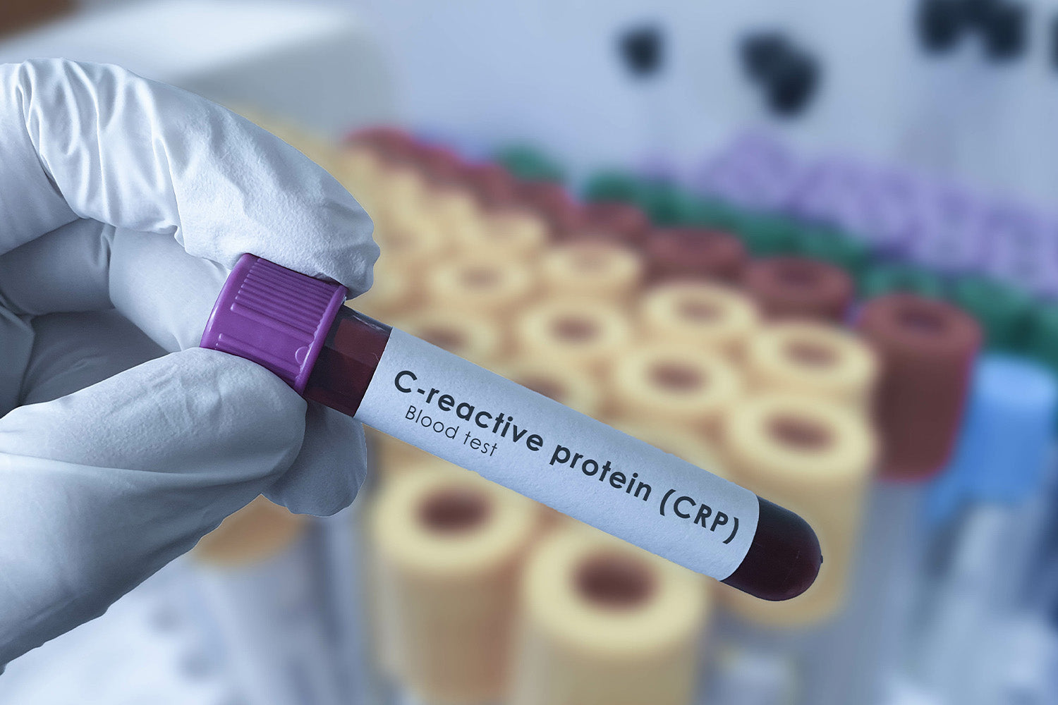 Gloved hand holding CRP blood test sample in lab.